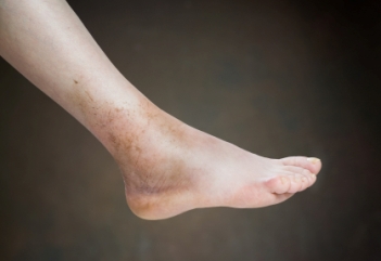 Ankle sprain showing discloration and bruising
