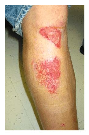 CA-MRSA skin infection