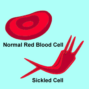 Normal blood cell and sickle cell 